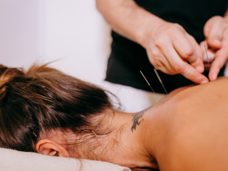 Dry needling terapija by Andrija Rusan
